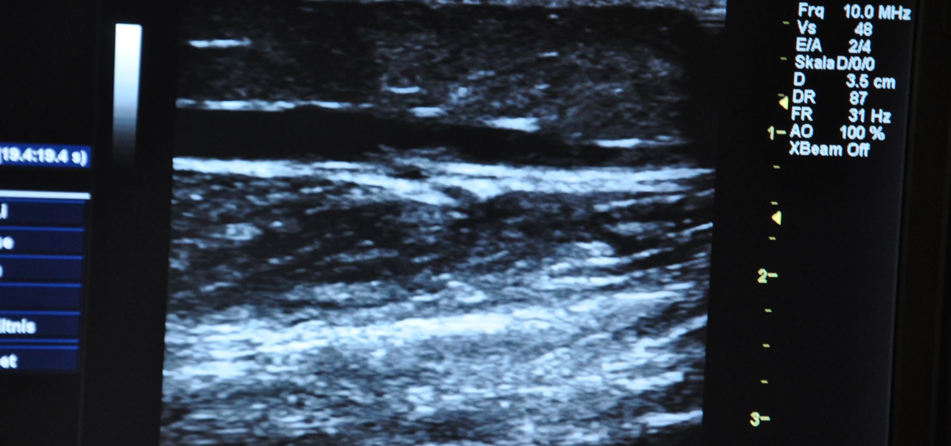 Wiederauftreten von Krampfadern 